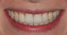 Adult Invisalign crowded teeth after treatment with straightened smile Fareham