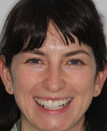 Adult Invisalign crowded lower incsor teeth before treatment face Fareham