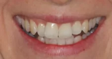 Adult Invisalign crowded lower incsor teeth before treatment Fareham
