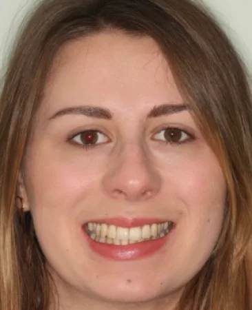 adult patient after invisalign treatment improving smile width and alignment in fareham