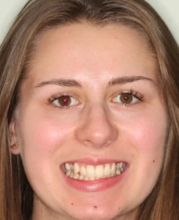 adult patient before invisalign treatment with narrow dental arch and misaligned teeth in fareham