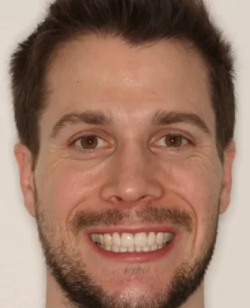 Adult Invisalign narrow smile after treatment with broader smile face Fareham