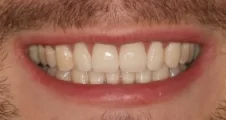 Adult Invisalign narrow smile after treatment with broader smile Fareham