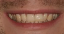 Adult Invisalign narrow smile before treatment Fareham