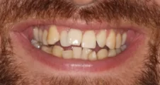 severely crowded teeth before orthodontic treatment requiring extractions in adult patient fareham