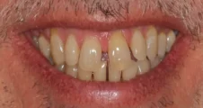 spaced teeth and uneven tooth edges before damon braces treatment in adult patient fareham