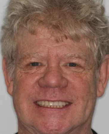 adult patient after spark aligners treatment and composite bonding restoring worn teeth in fareham