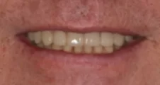 adult patient after spark aligners treatment and composite bonding restoring worn teeth in fareham