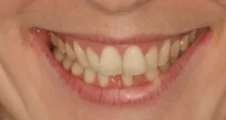 crooked lower teeth and narrow smile before spark aligner treatment in adult patient fareham