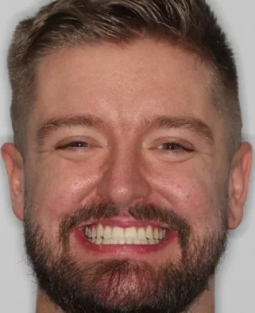 After - Angus Pringle Orthodontics