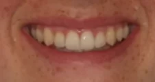 straightened teeth after spark aligner orthodontic treatment for crooked teeth