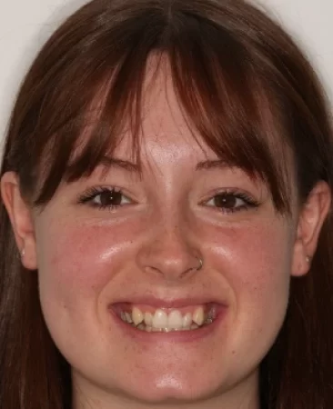 adult patient before spark aligner treatment for crooked teeth and narrow dental arch in fareham