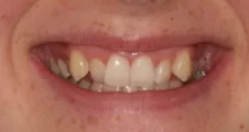 crooked teeth and narrow dental arch before spark aligner orthodontic treatment