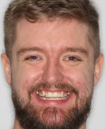 adult patient before spark aligners treatment with crooked teeth and prominent canines in fareham