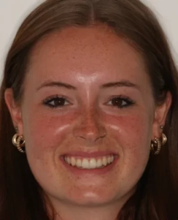 adult patient after spark aligner orthodontic treatment correcting crooked teeth and narrow arch