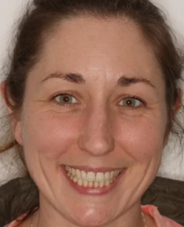 adult patient after spark aligners treatment improving smile width and alignment in fareham