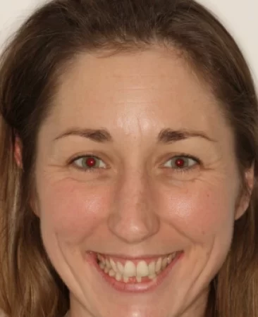 adult patient before spark aligners treatment with narrow smile and crooked lower teeth in fareham