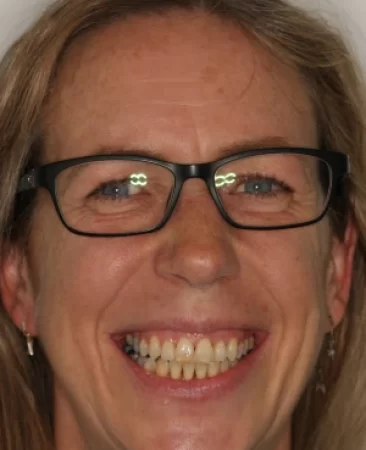 adult patient after spark aligners treatment correcting open bite and crossbite in fareham