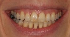 adult patient after spark aligners treatment correcting open bite crossbite and crowding in fareham