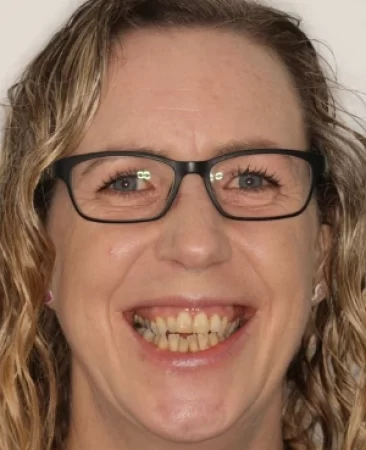 adult patient before spark aligners treatment with open bite crossbite and moderate crowding in fareham