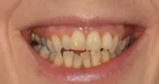 open bite crossbite and crowded teeth before spark aligner treatment in adult patient fareham