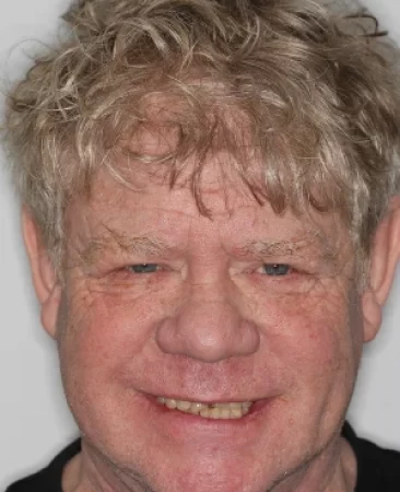 adult patient before spark aligners treatment for crooked teeth and worn down teeth in fareham