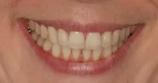 adult patient after spark aligners treatment correcting crooked lower teeth and narrow smile in fareham