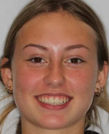 teenage patient after orthodontic treatment correcting class II bite with functional appliance and fixed braces