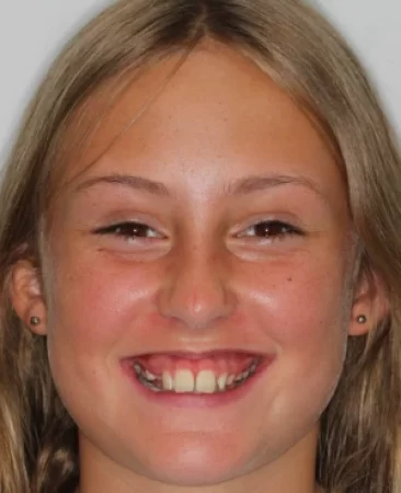 teenage patient with class II bite before orthodontic treatment with functional appliance and braces in fareham