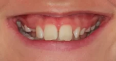 teen class II overbite and protruding teeth before functional appliance and braces treatment