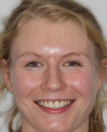 teenage patient after orthodontic treatment correcting overjet and bite with damon braces in fareham