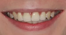 teenage patient after damon braces treatment correcting class II bite and overjet in fareham