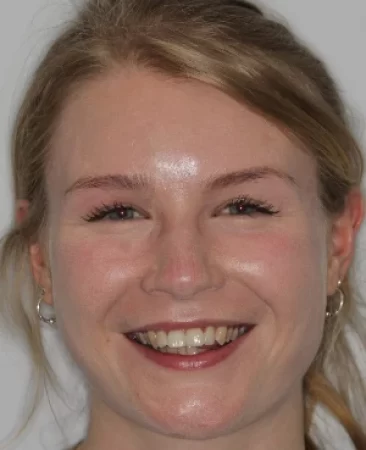 teenage patient before damon braces treatment with class II division 2 bite and increased overjet in fareham