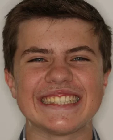 teenage patient after damon braces treatment for large gap between front teeth and uneven edges of teeth in fareham