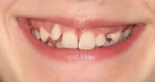 impacted canines crowding and deep overbite before damon fixed braces treatment