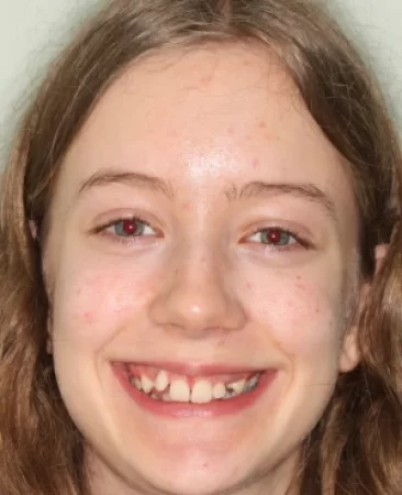 teenage patient before orthodontic treatment with impacted canines deep overbite and crowding