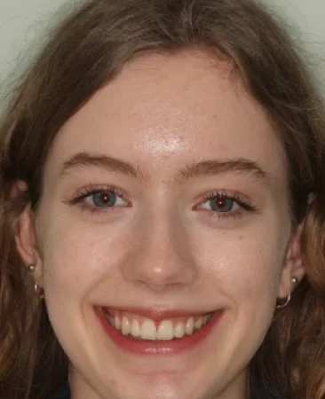 teenage patient after damon braces treatment correcting impacted canines and deep overbite