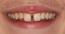 teenage patient before damon braces treatment for large gap between front teeth and uneven edges of teeth in fareham