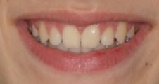 teenage patient after damon braces treatment closing large gap between front teeth and correcting overbite