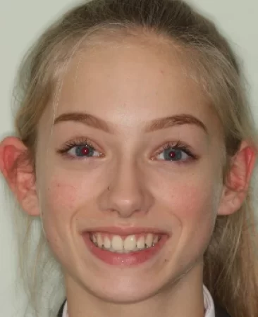 teenage patient after orthodontic treatment with damon braces closing midline diastema in fareham