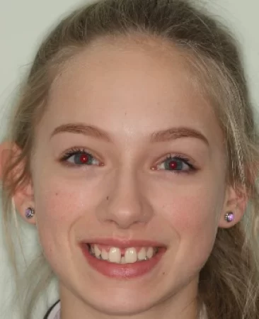 teenage patient before damon braces treatment with large midline diastema and overbite in fareham