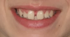 teenage patient with large midline diastema and overbite before damon braces treatment in fareham