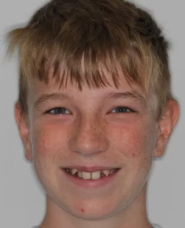 teenage patient with severe dental crowding before damon fixed braces treatment in fareham