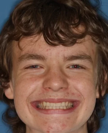 Teen fixed braces underbite after treatment with improved bite face Fareham