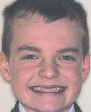 Teen fixed braces underbite before treatment face Fareham