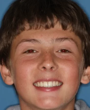 Teen fixed braces crooked teeth after extraction treatment with straightened smile face Fareham