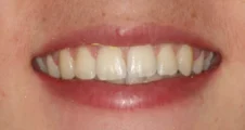 Teen fixed braces crooked teeth after extraction treatment with straightened smile face Fareham