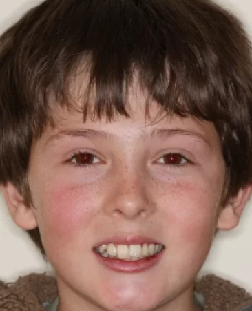 Teen fixed braces crooked teeth before extraction treatment face Fareham