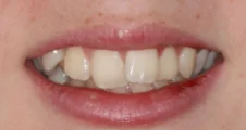 Teen fixed braces crooked teeth before extraction treatment smile Fareham