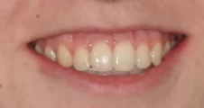 Teen fixed braces crooked teeth after treatment with straightened smile Fareham